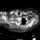 Neurofibroma of the thorax: CT - Computed tomography